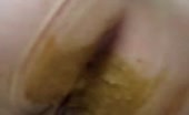 Mix of girls with diarheea