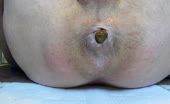 Man shitting out a long brown turd on a blue pad