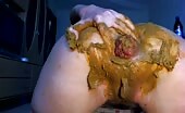 Anal prolapse after rough masturbation