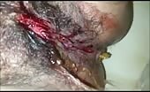 Man pissing blood from torn ass